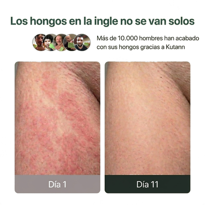 Kutann® — Jabón Antifúngico de Árbol de Té | Piel sana en 14 días