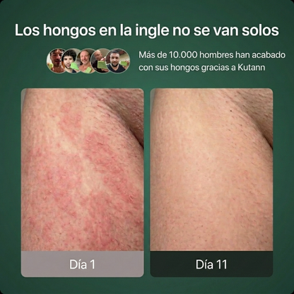 Kutann® — Jabón Antifúngico de Árbol de Té | Piel sana en 14 días