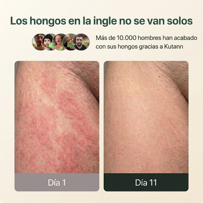 Kutann® — Jabón Antifúngico de Árbol de Té | Piel sana en 14 días